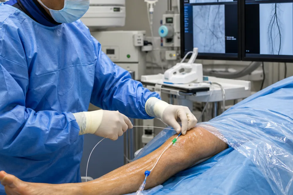 Angioplastia arteria para procedimientos de revascularización